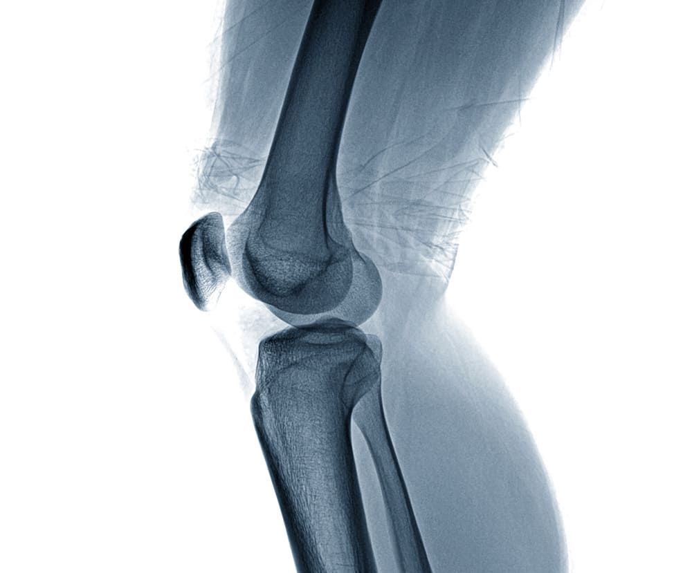 Knie-Endoprothetik in Wien | knstliches Kniegelenk